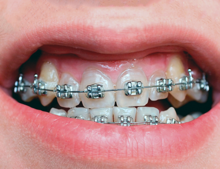 aparat-dentar