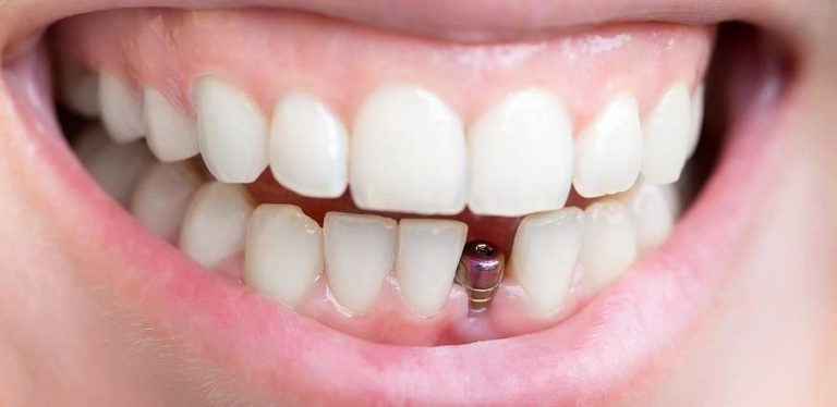 implant-dentar